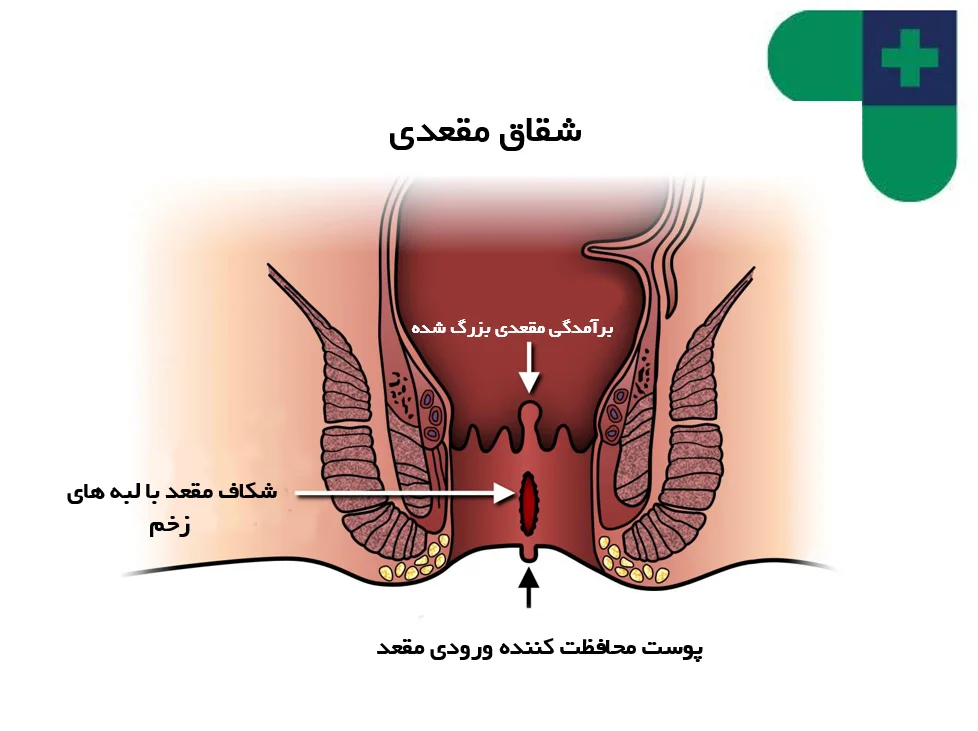 فیشر یا شقاق مقعدی